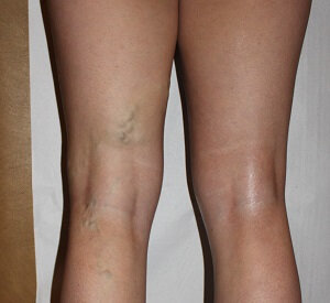 My legs prior to the application of the NanoVein