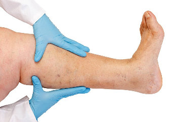 NanoVein is used for the treatment of varicose veins, thrombosis disease