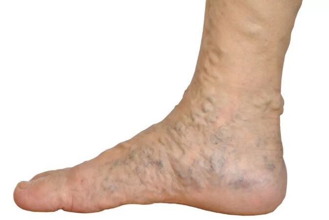 Veen diseases on the legs