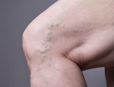 Varicose veins