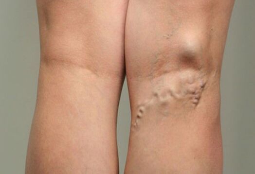 Vein disease