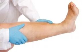 Swelling of the lower limb