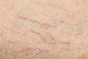 Vascular stars