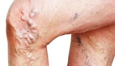 The main manifestations of the varicose veins on the legs