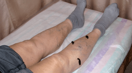 treatment of varicose veins with leeches