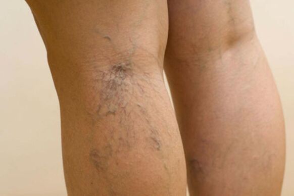 varicose veins in women's legs