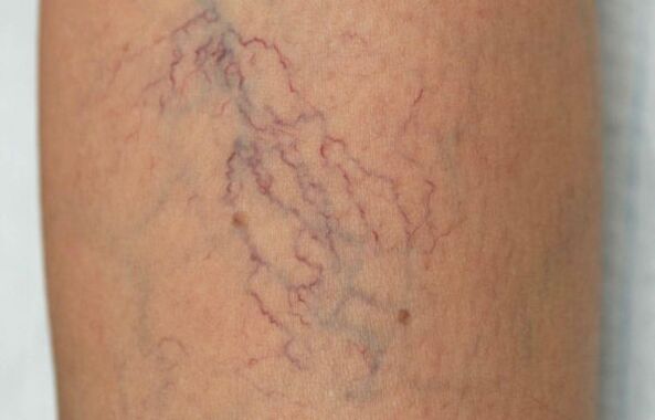 varicose veins on the legs in women