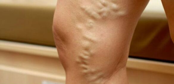 varicose veins on women's legs