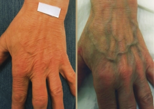 causes of varicose veins on the hands