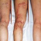 Varicose veins of the legs