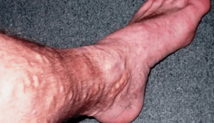 causes of varicose veins on the legs in men