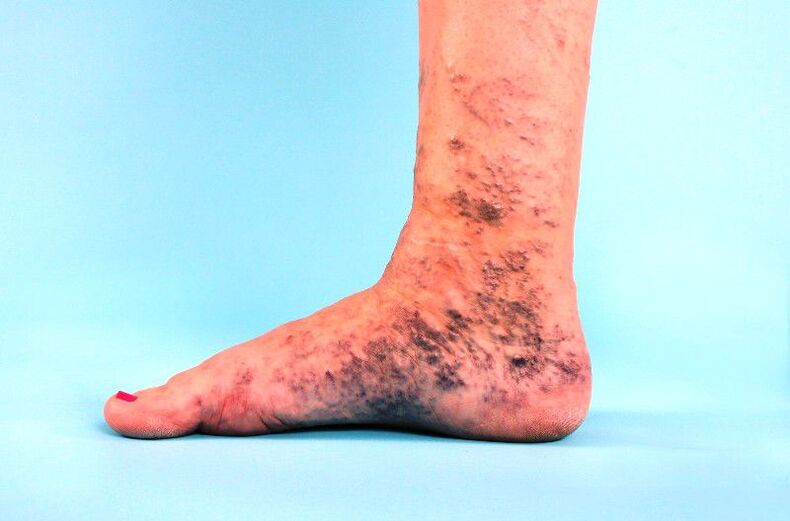 neglected varicose veins on the leg