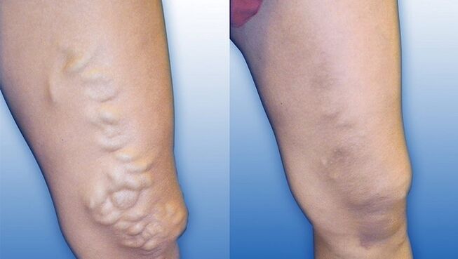 Legs before and after the treatment of severe varicose veins