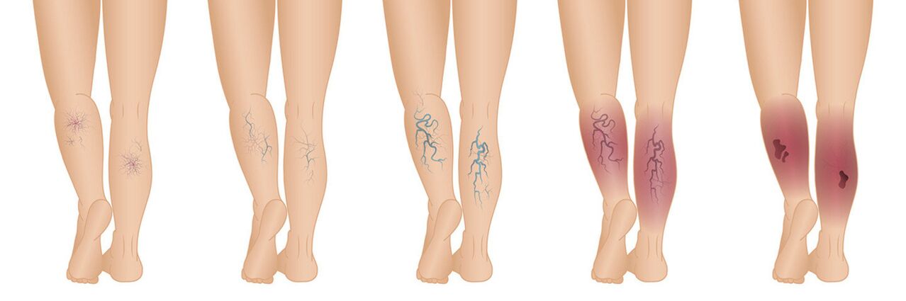 Stages of varicose veins of the lower limbs