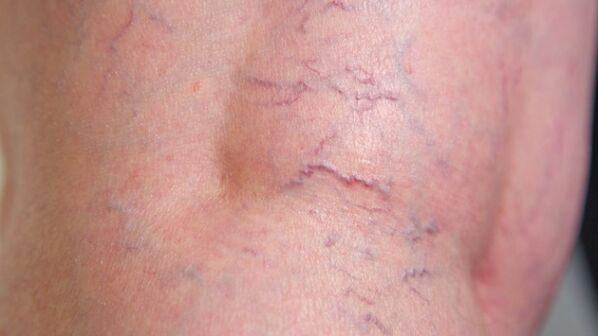 Signs of reticular varicose veins of the lower extremities - dilation of thin veins and vascular mesh