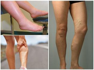 the consequences of varicose veins