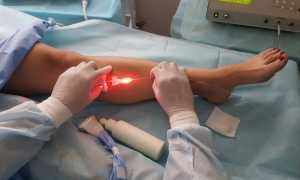 the operation of varicose veins