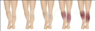Varicose veins of the lower limbs - stage
