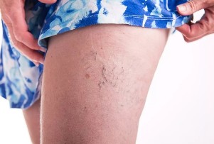 The spider veins on the legs
